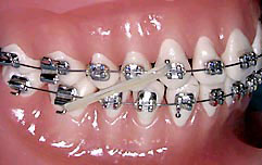 How to and why wear your elastic orthodontic bands